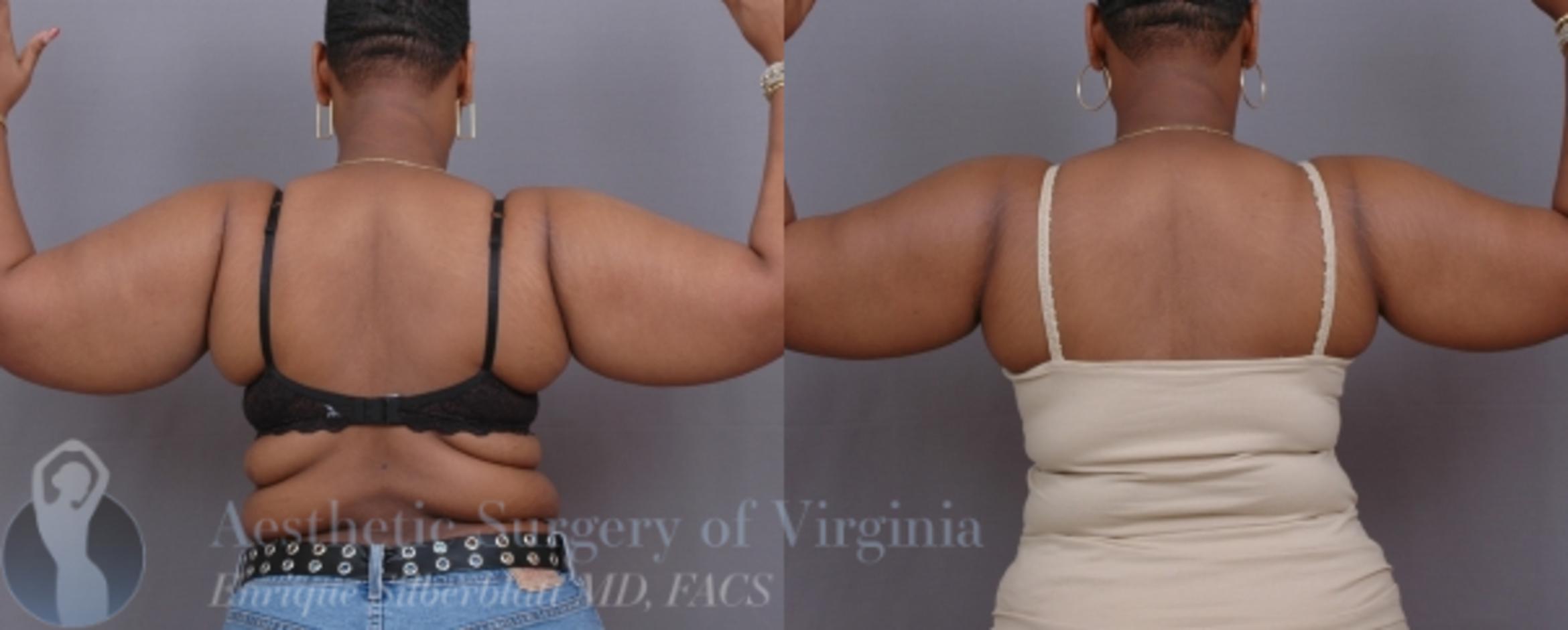 Arm Lift Surgery Case 31 Before & After View #1 | Roanoke, VA | Aesthetic Surgery of Virginia: Enrique Silberblatt, MD