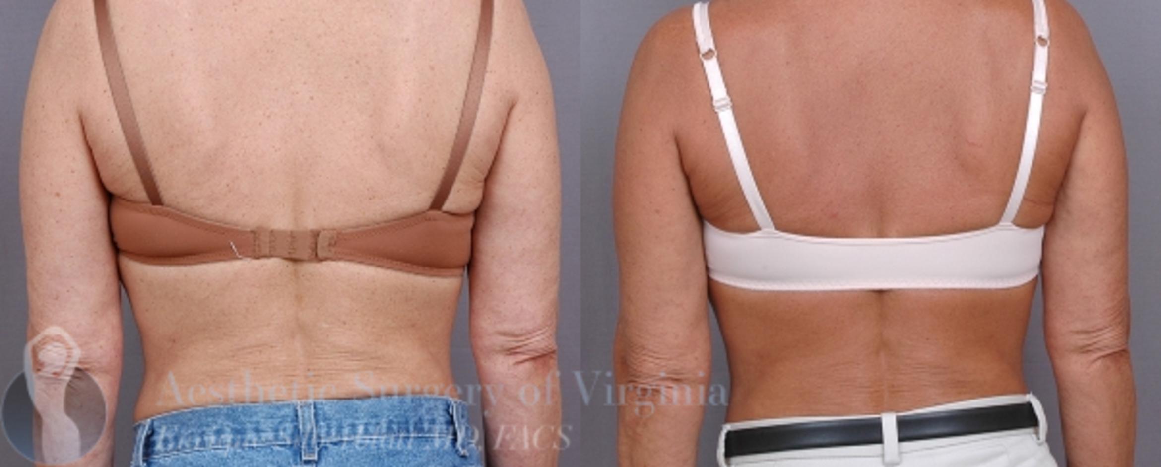 Arm Lift Surgery Case 32 Before & After View #1 | Roanoke, VA | Aesthetic Surgery of Virginia: Enrique Silberblatt, MD