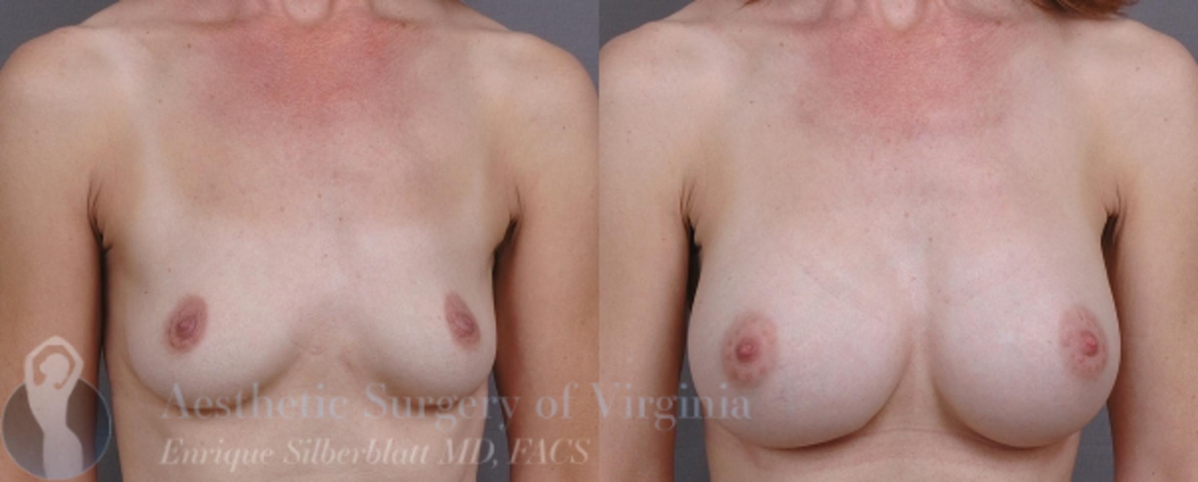 Breast Augmentation Case 10 Before & After View #1 | Roanoke, VA | Aesthetic Surgery of Virginia: Enrique Silberblatt, MD