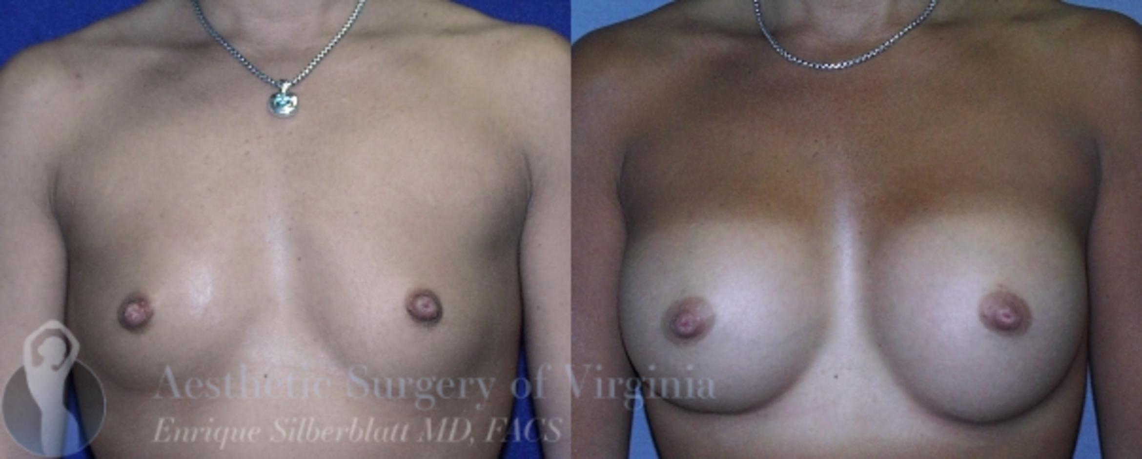 Breast Augmentation Case 11 Before & After View #1 | Roanoke, VA | Aesthetic Surgery of Virginia: Enrique Silberblatt, MD