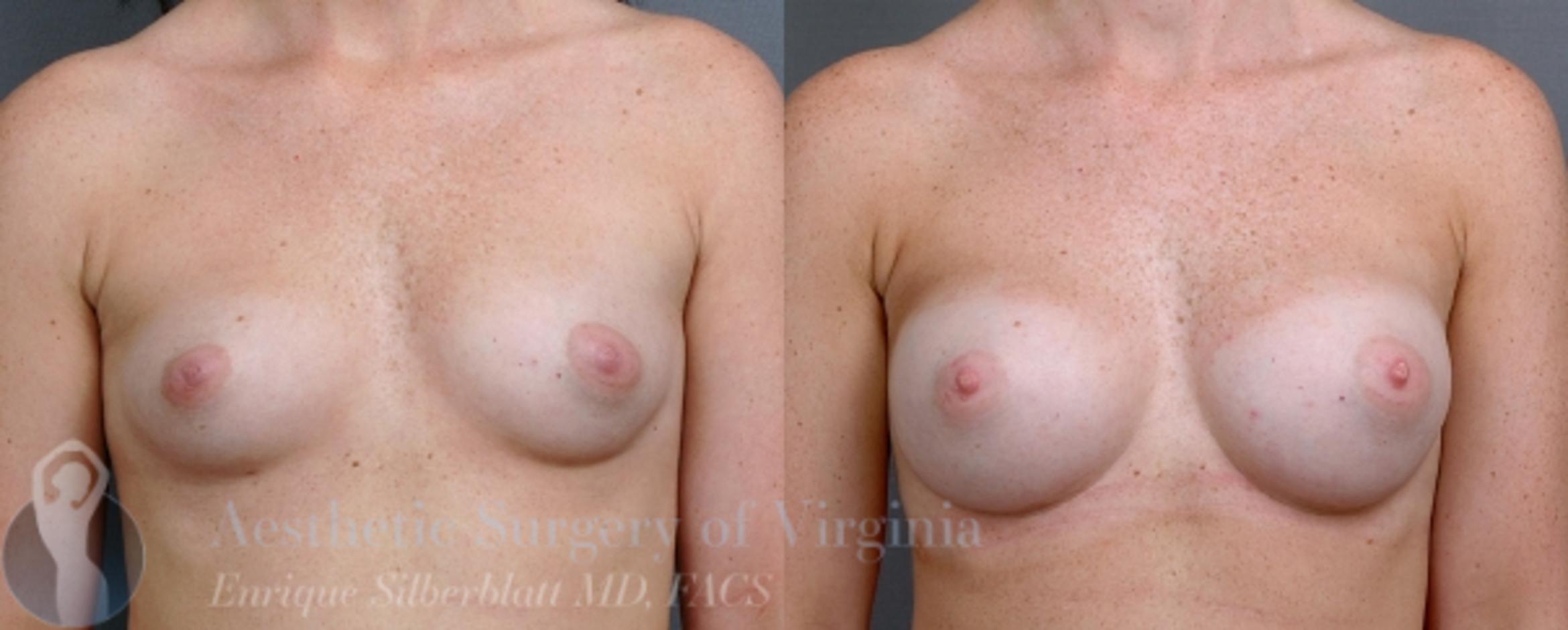 Breast Augmentation Case 13 Before & After View #1 | Roanoke, VA | Aesthetic Surgery of Virginia: Enrique Silberblatt, MD