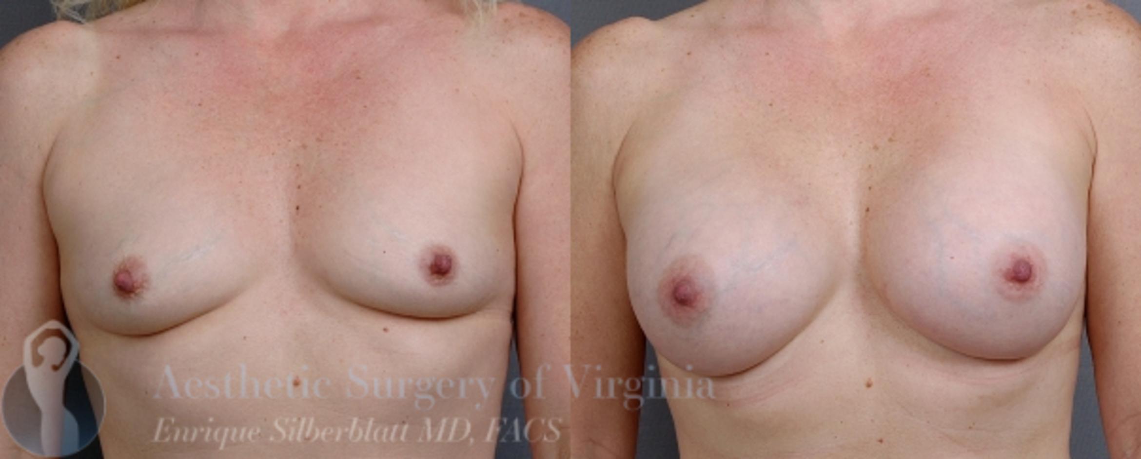 Breast Augmentation Case 14 Before & After View #1 | Roanoke, VA | Aesthetic Surgery of Virginia: Enrique Silberblatt, MD