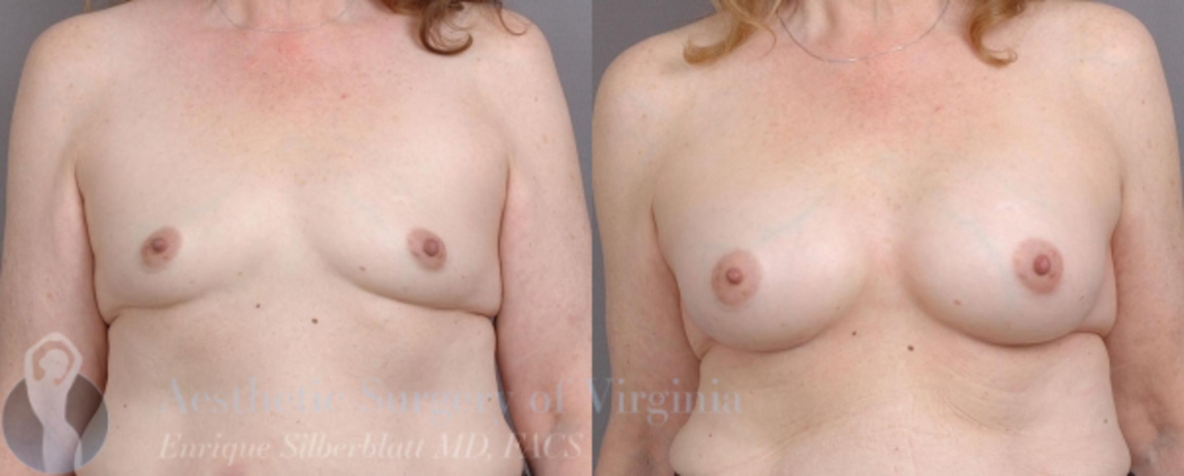 Breast Augmentation Case 16 Before & After View #1 | Roanoke, VA | Aesthetic Surgery of Virginia: Enrique Silberblatt, MD
