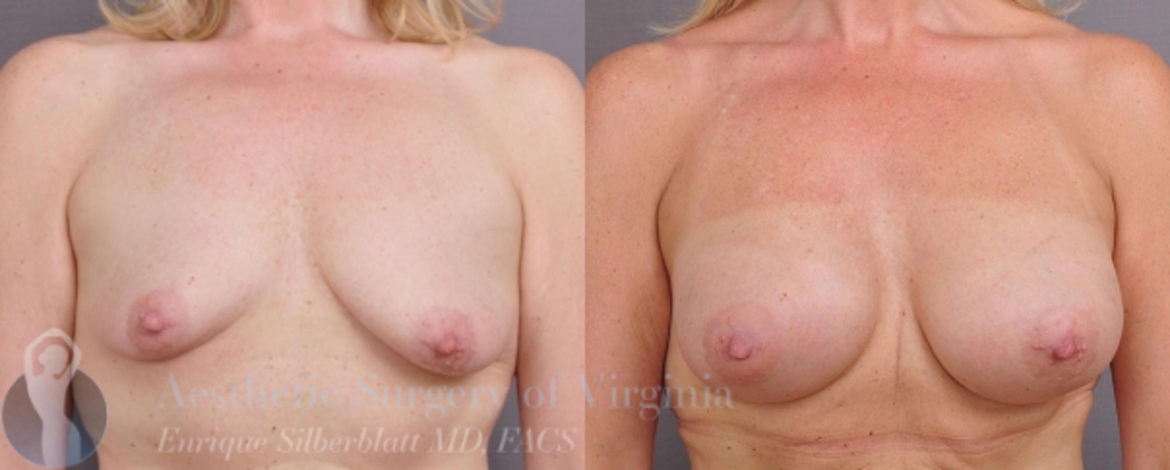 Breast Augmentation Case 18 Before & After View #1 | Roanoke, VA | Aesthetic Surgery of Virginia: Enrique Silberblatt, MD