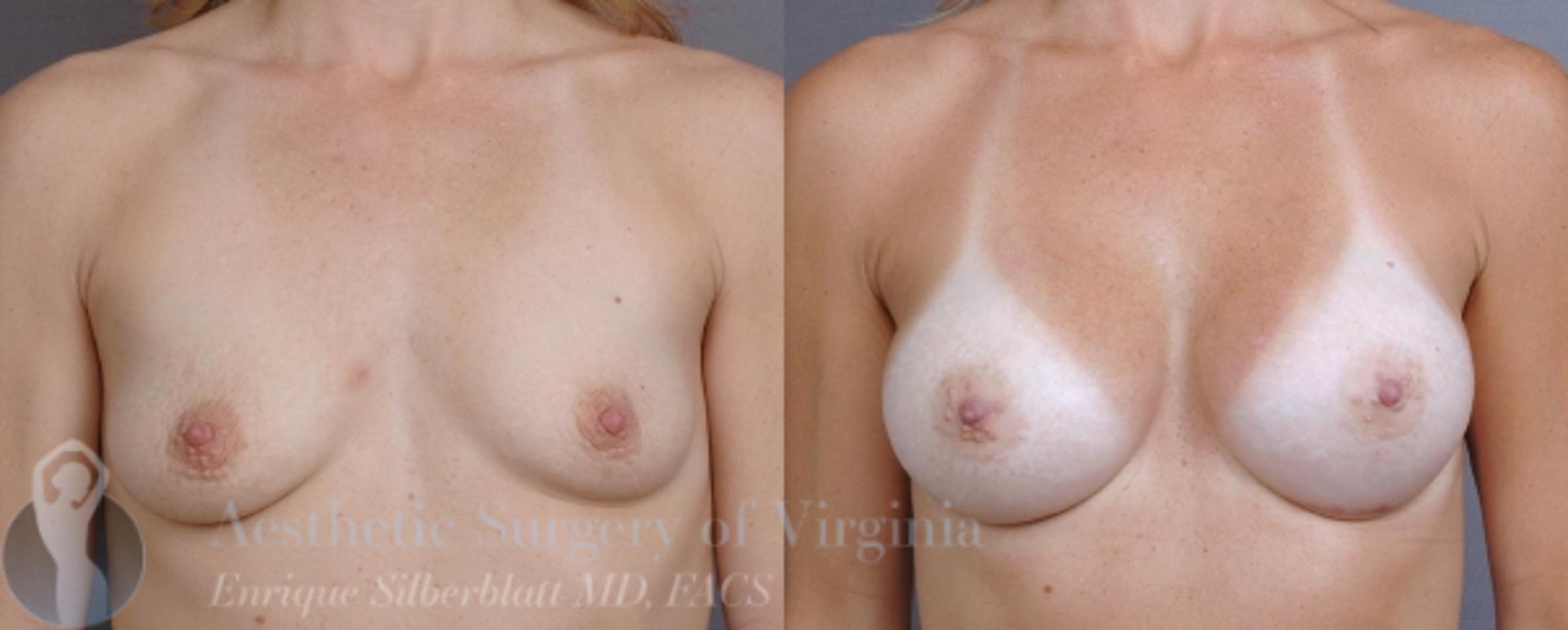 Breast Augmentation Case 5 Before & After View #1 | Roanoke, VA | Aesthetic Surgery of Virginia: Enrique Silberblatt, MD