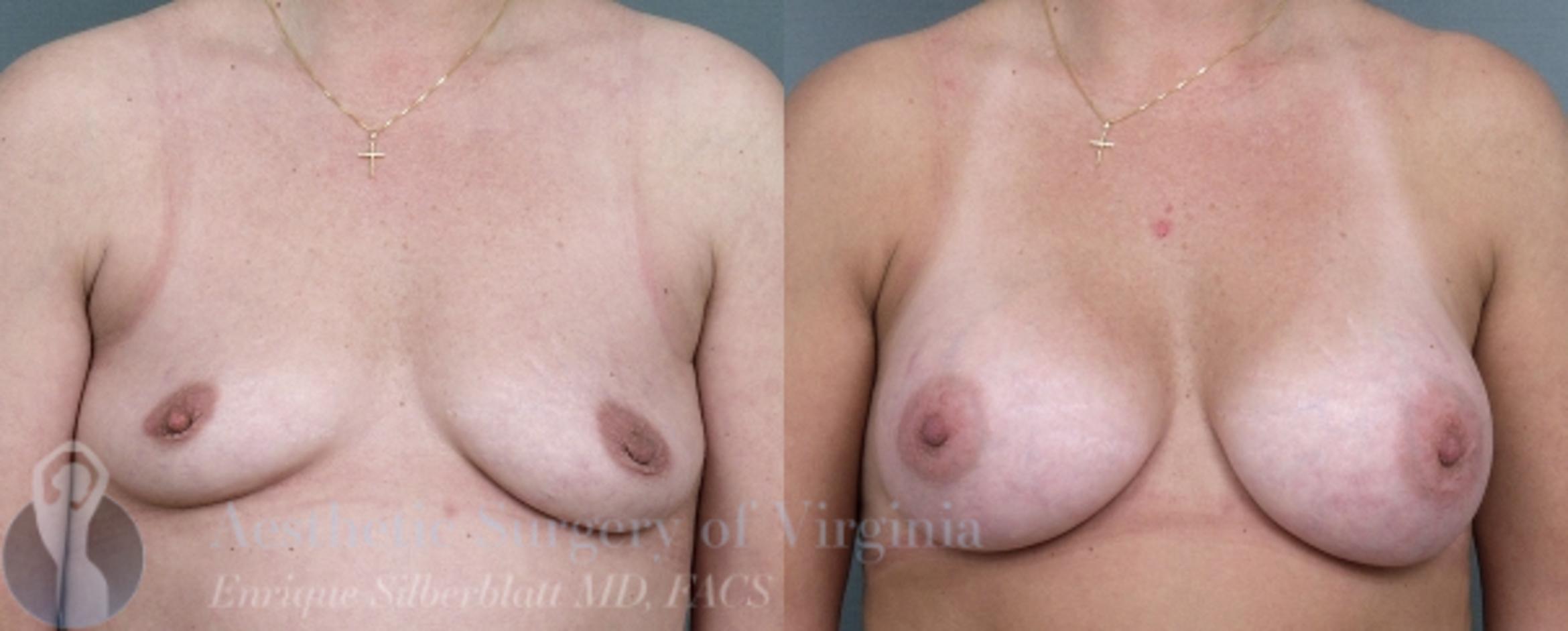 Breast Augmentation Case 8 Before & After View #1 | Roanoke, VA | Aesthetic Surgery of Virginia: Enrique Silberblatt, MD