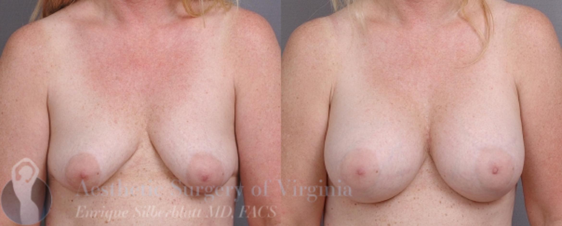 Breast Augmentation Case 9 Before & After View #1 | Roanoke, VA | Aesthetic Surgery of Virginia: Enrique Silberblatt, MD