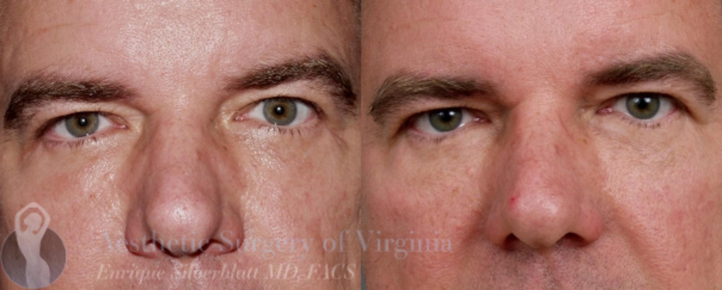 Eyelid Surgery Case 43 Before & After View #1 | Roanoke, VA | Aesthetic Surgery of Virginia: Enrique Silberblatt, MD