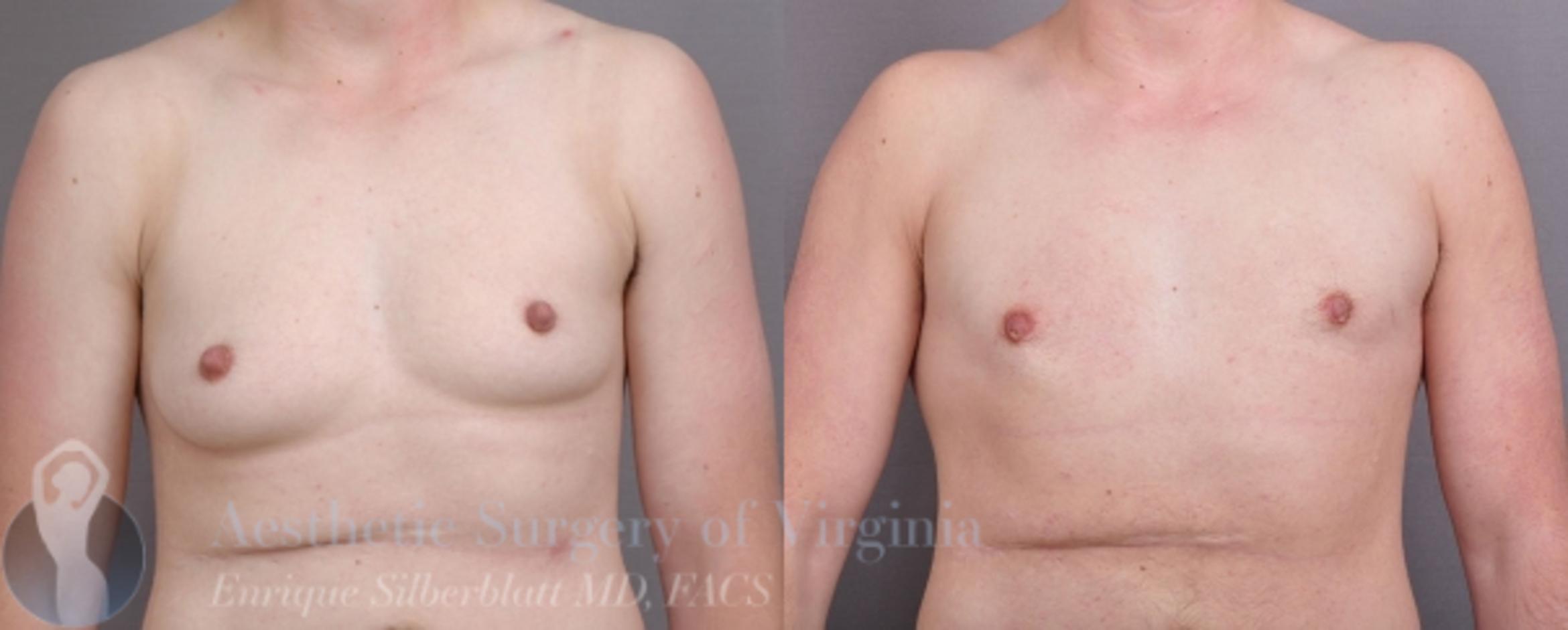 Female to Male Breast Surgery Case 56 Before & After View #1 | Roanoke, VA | Aesthetic Surgery of Virginia: Enrique Silberblatt, MD