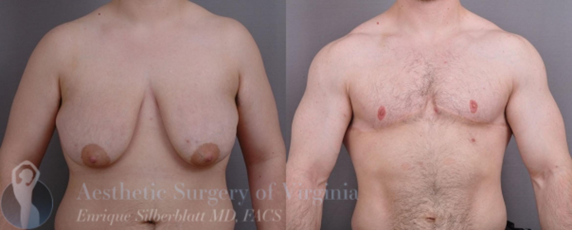 Female to Male Breast Surgery Case 57 Before & After View #1 | Roanoke, VA | Aesthetic Surgery of Virginia: Enrique Silberblatt, MD