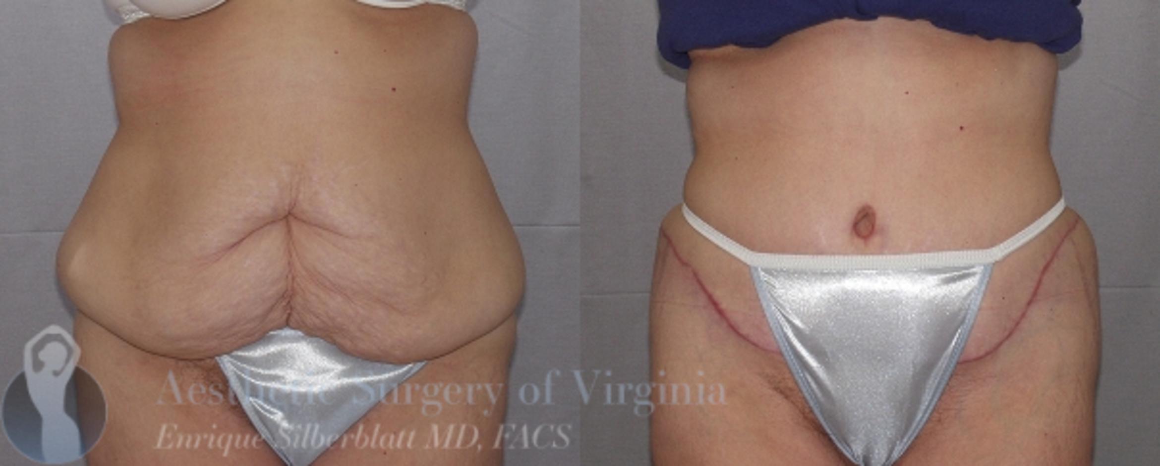 Tummy Tuck Case 25 Before & After View #1 | Roanoke, VA | Aesthetic Surgery of Virginia: Enrique Silberblatt, MD