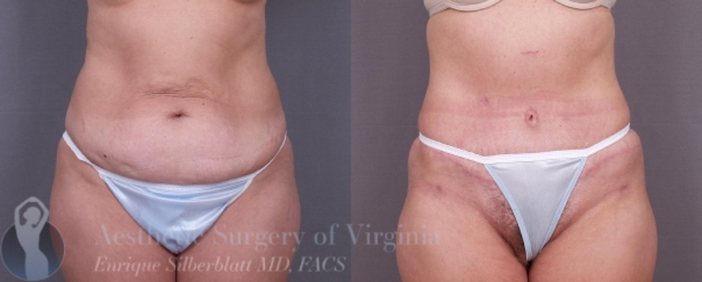 Tummy Tuck Case 26 Before & After View #1 | Roanoke, VA | Aesthetic Surgery of Virginia: Enrique Silberblatt, MD
