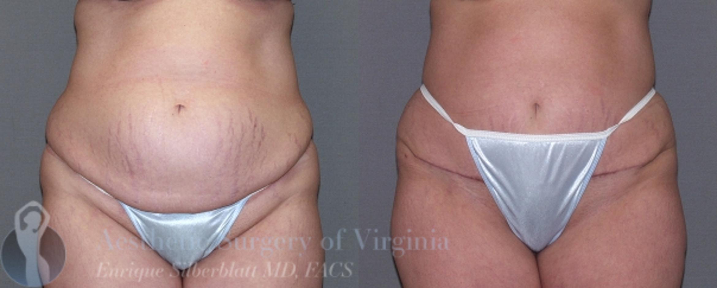 Tummy Tuck Case 28 Before & After View #1 | Roanoke, VA | Aesthetic Surgery of Virginia: Enrique Silberblatt, MD