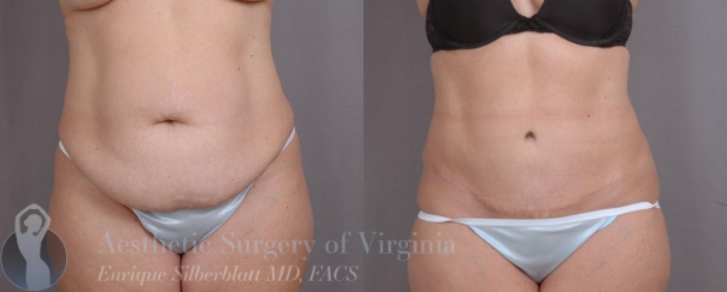 Tummy Tuck Case 29 Before & After View #1 | Roanoke, VA | Aesthetic Surgery of Virginia: Enrique Silberblatt, MD
