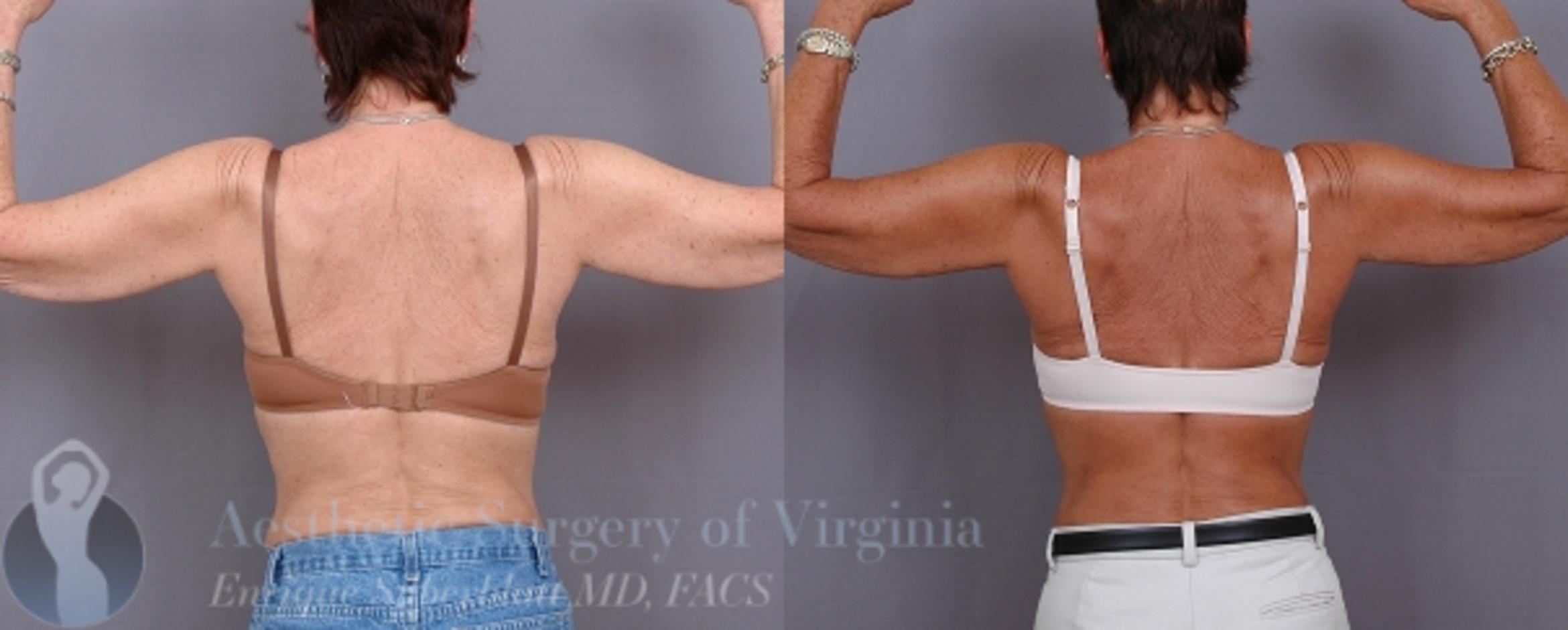 Arm Lift Surgery Before After Photos Patient 32 Roanoke Va Aesthetic Surgery Of Virginia Enrique Silberblatt Md Arm Lift Surgery Before After Photos Patient 32 Roanoke Va Aesthetic Surgery Of Virginia Enrique Silberblatt Md