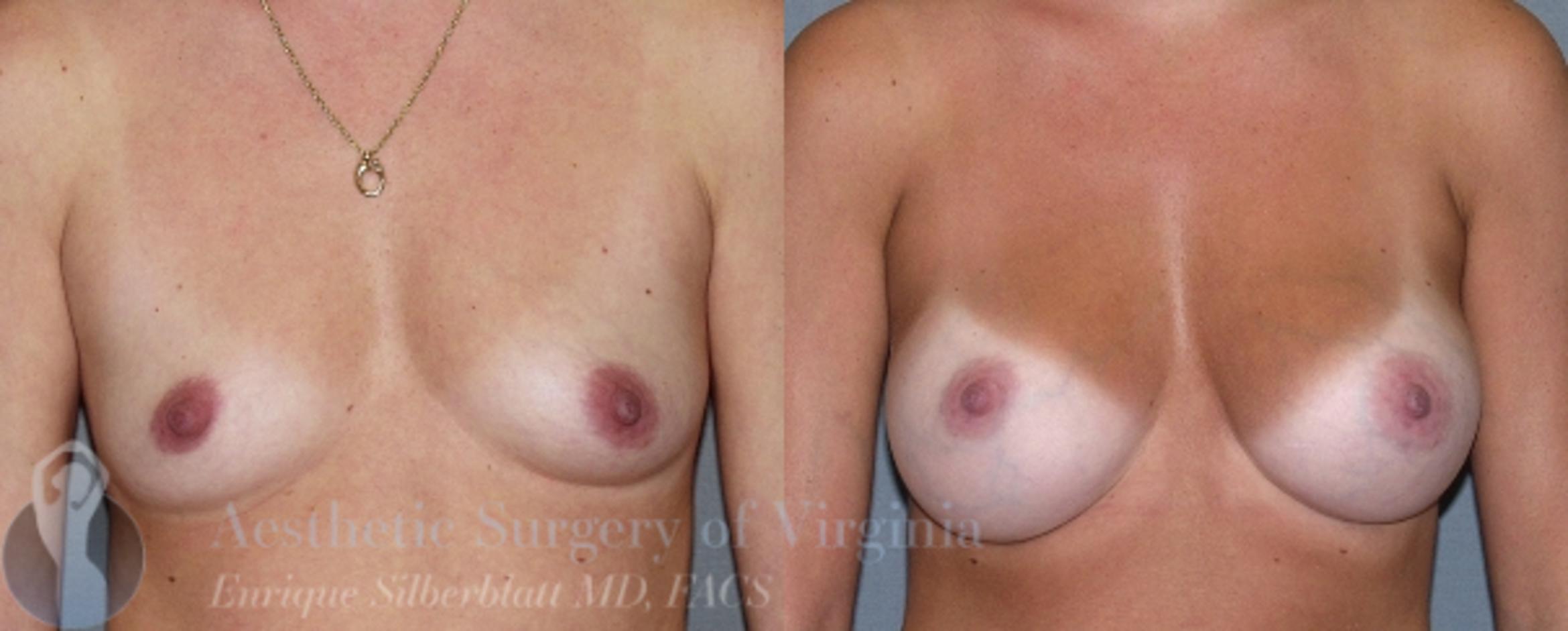 Breast Augmentation Case 6 Before & After View #1 | Roanoke, VA | Aesthetic Surgery of Virginia: Enrique Silberblatt, MD