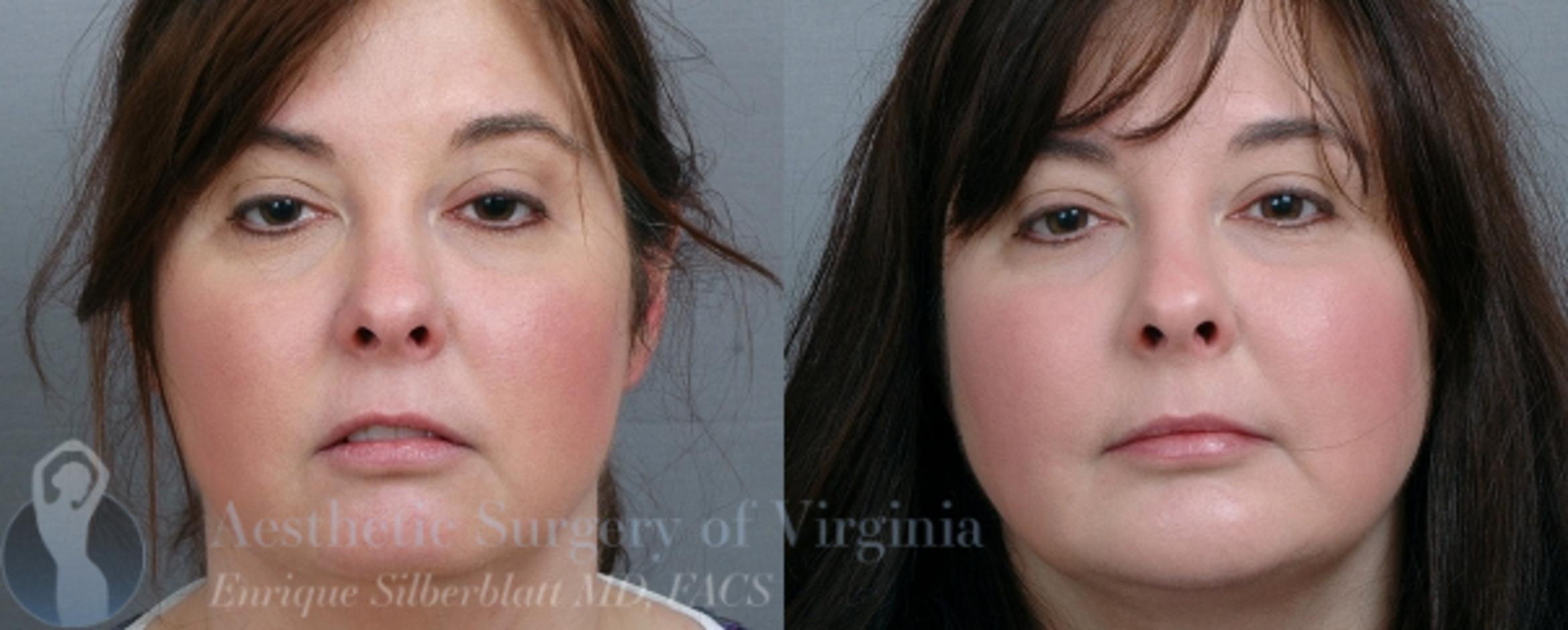 Chin Implant Before After Photos Patient 50 Roanoke Va Aesthetic Surgery Of Virginia Enrique Silberblatt Md