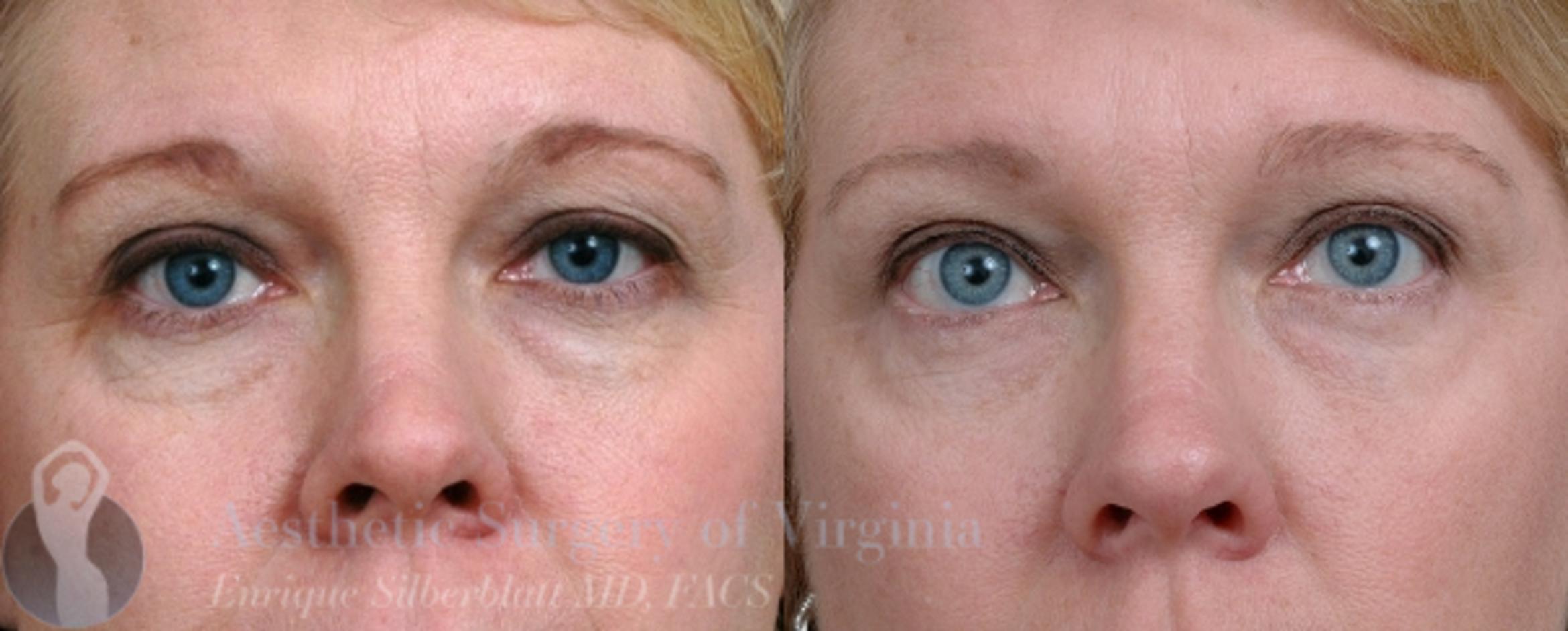 Eyelid Surgery Before & After Photos Patient 44 | Roanoke ...