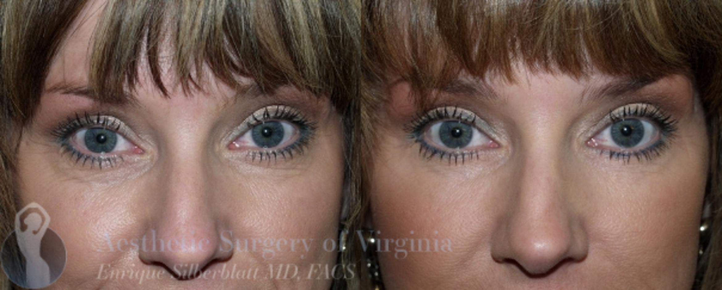 Eyelid Surgery Case 45 Before & After View #1 | Roanoke, VA | Aesthetic Surgery of Virginia: Enrique Silberblatt, MD