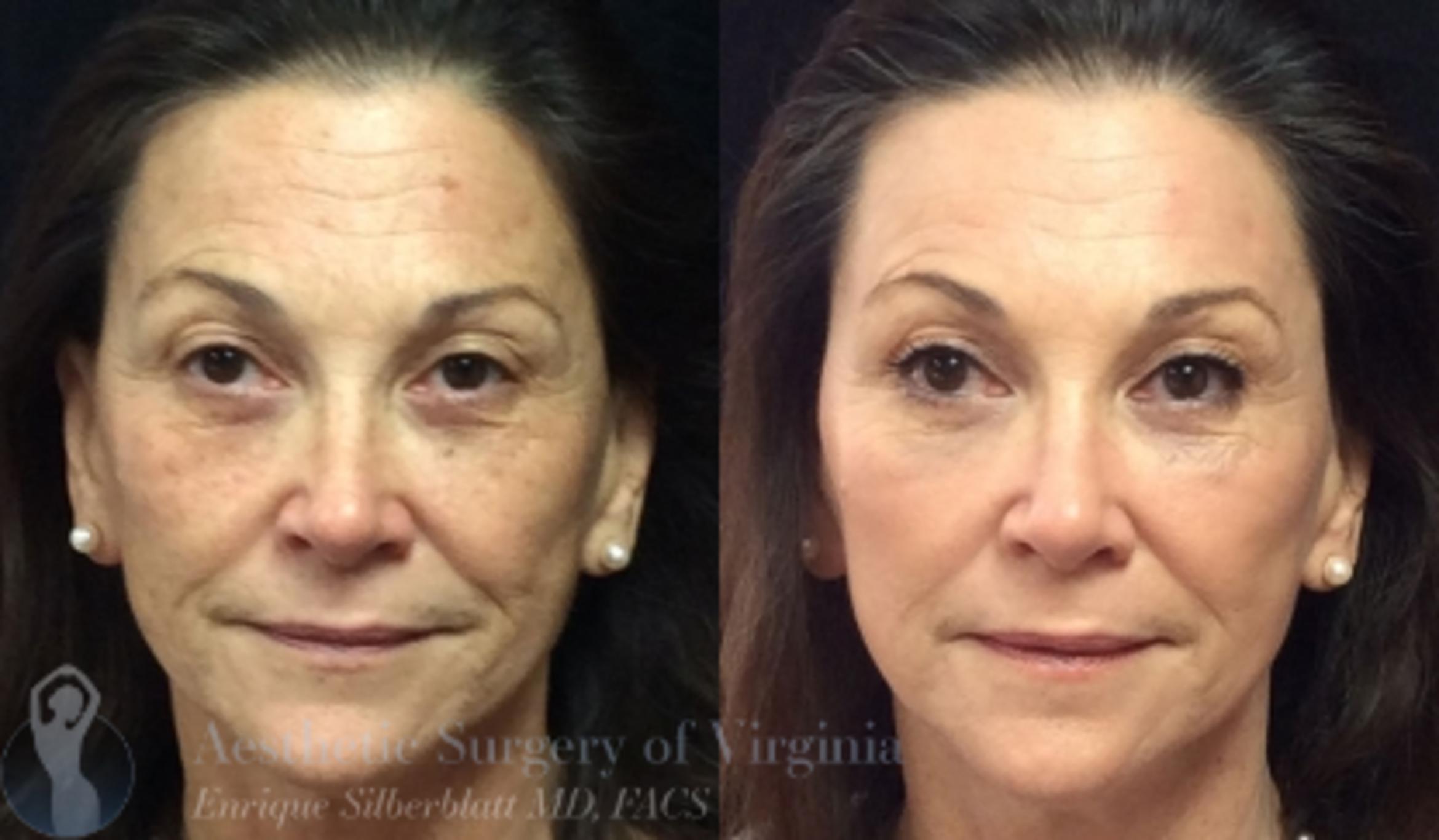 Fraxel Laser Skin Resurfacing In Roanoke Va Aesthetic Surgery Of Virginia