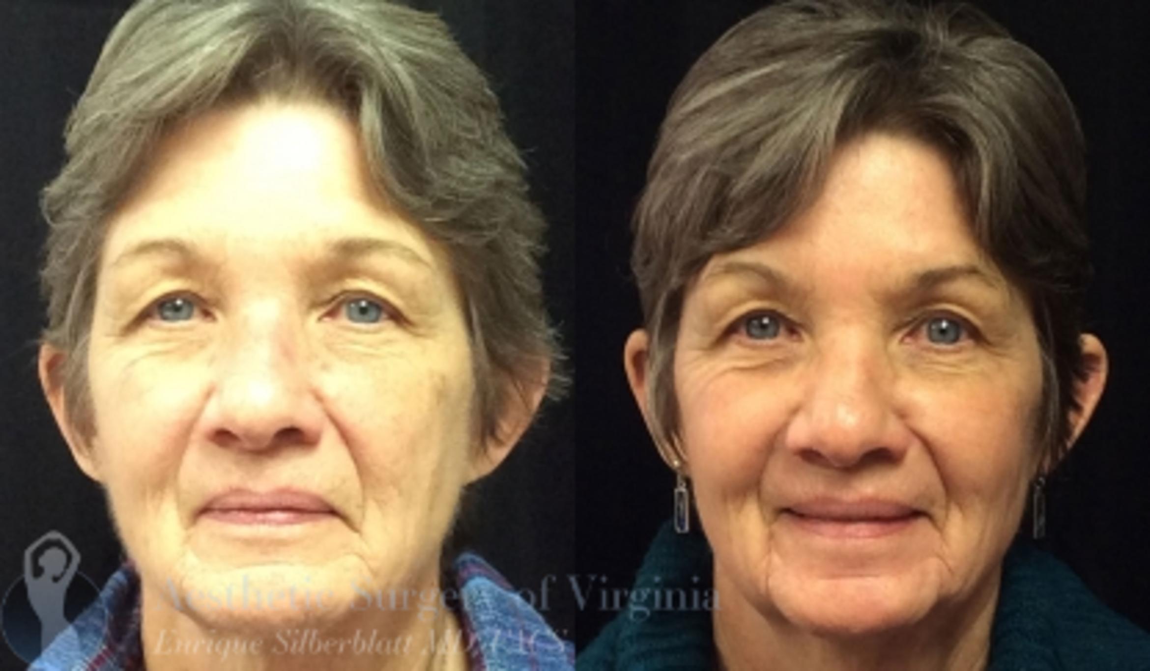 Fraxel Laser Skin Resurfacing In Roanoke Va Aesthetic Surgery Of Virginia