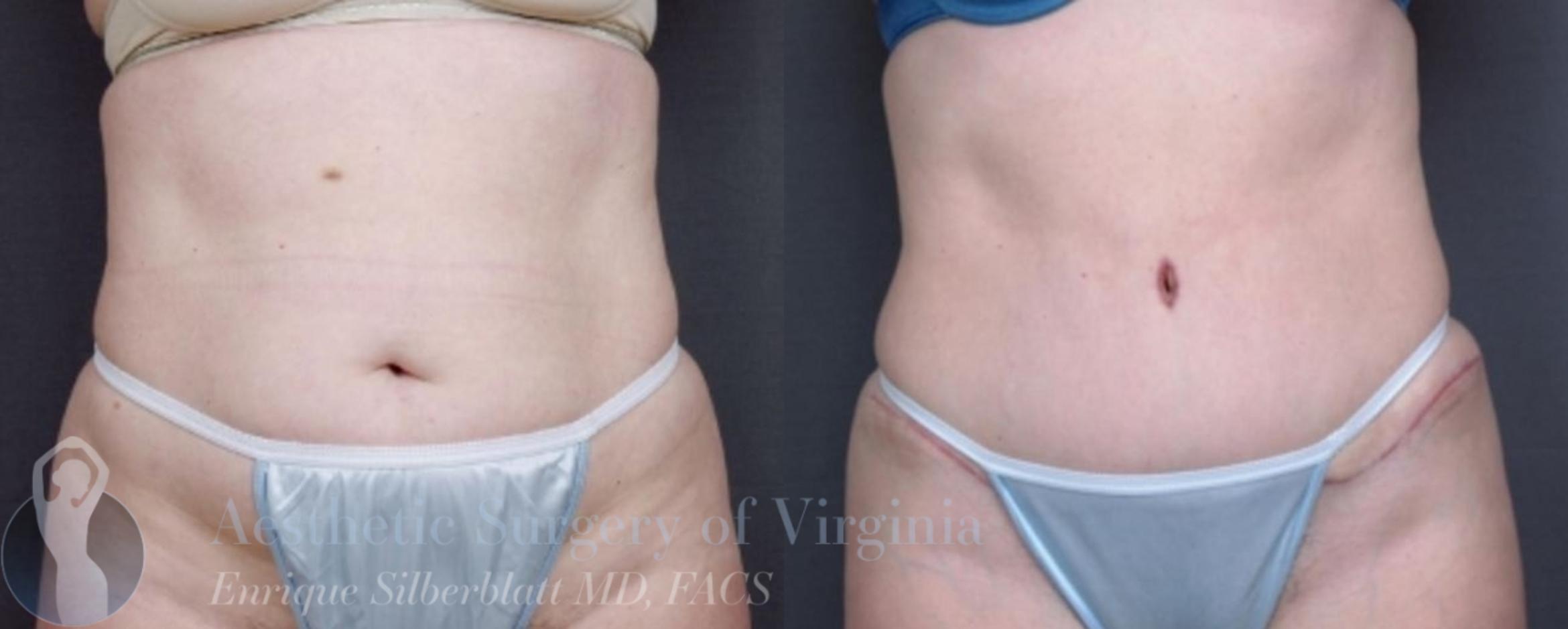 Tummy Tuck Case 27 Before & After Front | Roanoke, VA | Aesthetic Surgery of Virginia: Enrique Silberblatt, MD
