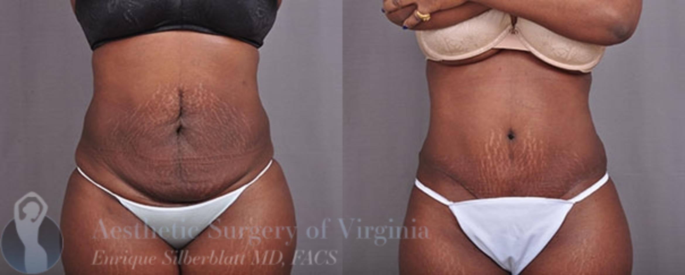 Tummy Tuck Austin Tx